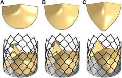 Fluid-Structure Interaction Analysis on the Influence of the Aortic Valve Stent Leaflet Structure in Hemodynamics